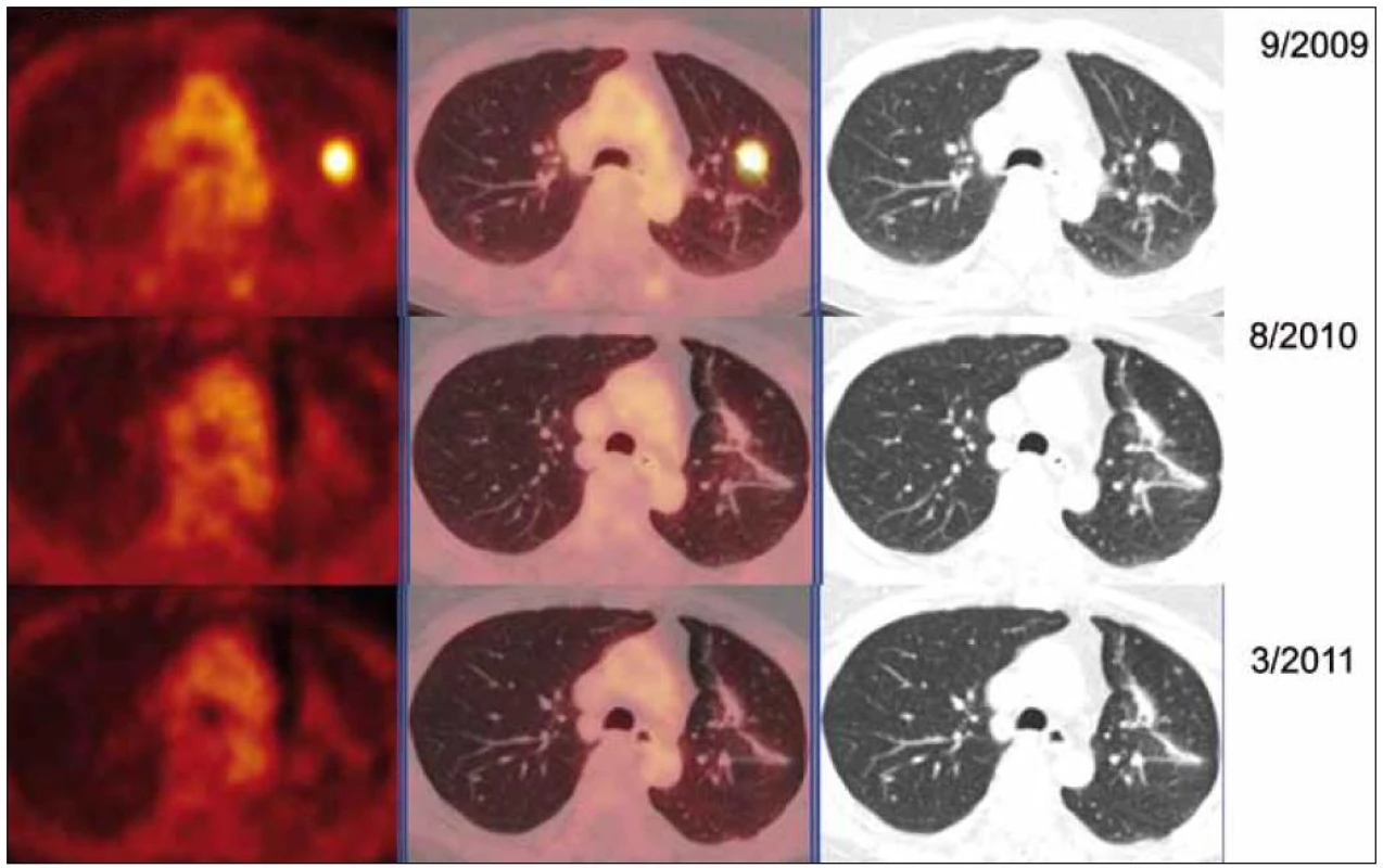 PET-CT zobrazení plicních ložisek v čase (září roku 2009, srpen roku 2010, březen roku 2011), axiální řezy, ve sloupcích zleva PET, PET/CT a CT. PET obraz je v barevné škále „Hot Body“, řazeno odshora. Metabolicky aktivní ložisko (SUV&lt;sub&gt;max&lt;/sub&gt; 8,03 velikosti 20 × 16 mm) v S1/2 v levém plicním křídle bylo patrné pouze na vyšetření v září roku 2009, toto ložisko bylo operativně odstraněno, a proto dále pozorujeme jen jizevnaté změny, bez vývoje.