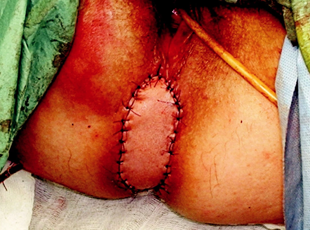 Pacientka č. 1 – výsledný stav – perineum
Fig. 3. Outcome of VRAM flap – perineum