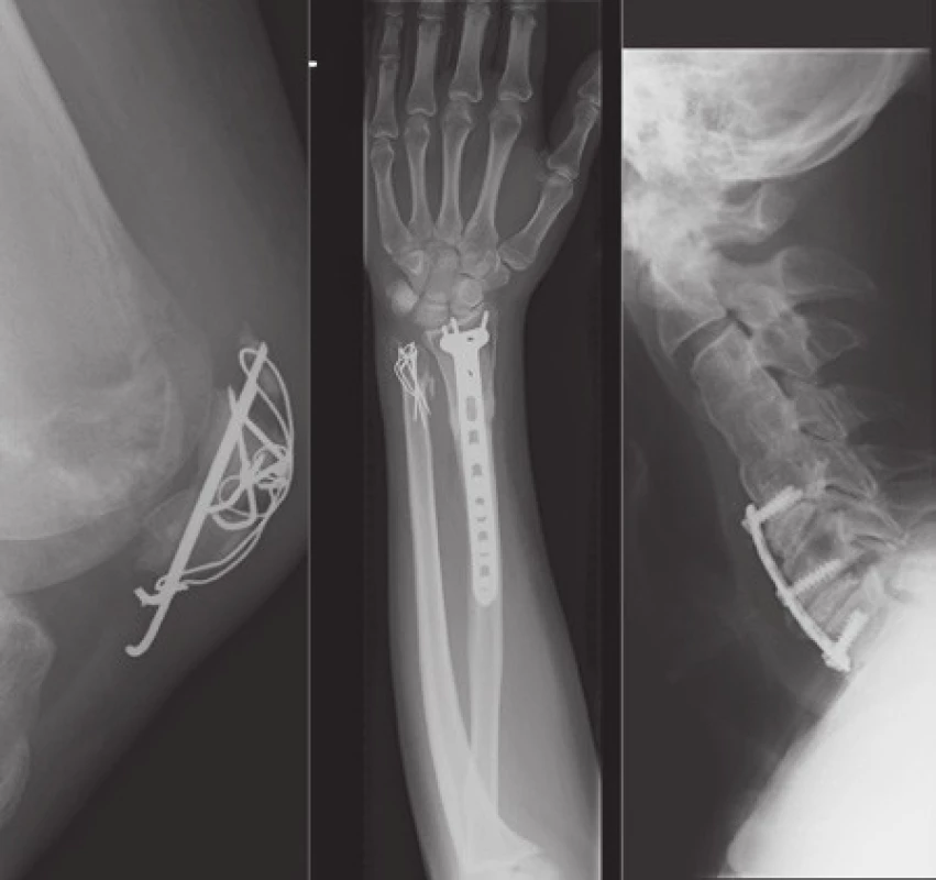 Implantované chirurgické materiály prokázané rentgenovým snímkem mohou sloužit jako jedna z identifikačních markant při pitvě těla neznámé totožnosti.