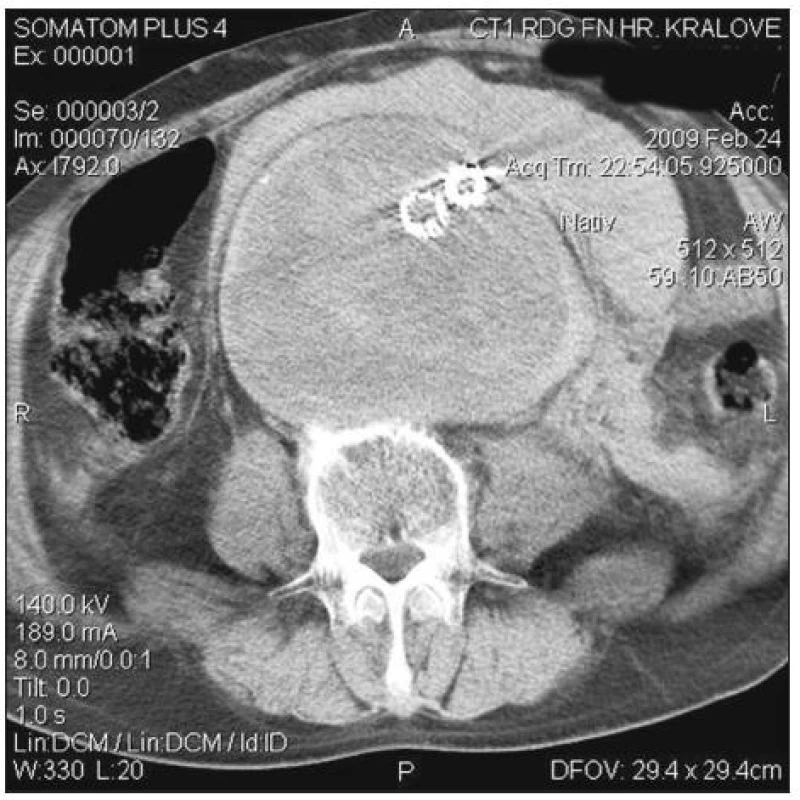 Urgentní CT 6 hodin po endovaskulárním ošetření (zvětšení vaku, retroperitoneální hematom)
Fig. 4. An urgent CT 6 hours after endovascular treatement (enlargement of sac, retroperitoneal hematoma)
