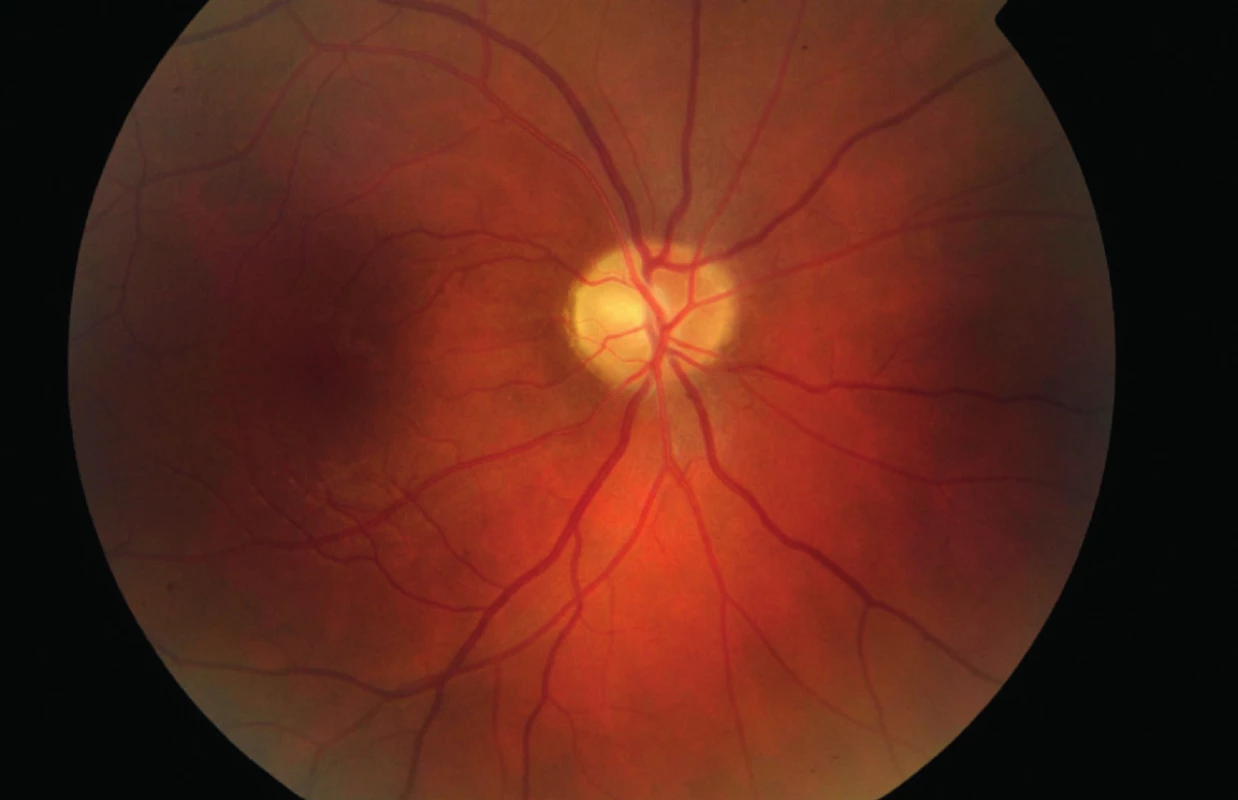 Očné pozadie pravého oka (7/2013) – bledšia papila zrakového nervu.