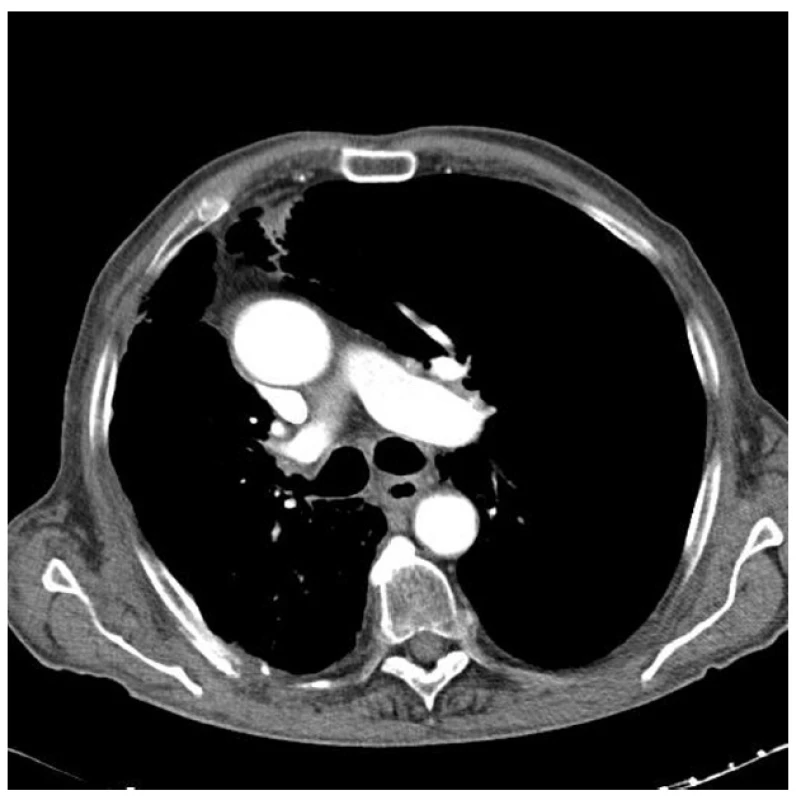 CT plic 6 měsíců po IRE
Fig. 5: Lung CT six months after IRE – no tumour marks are seen, the airways are completely free
