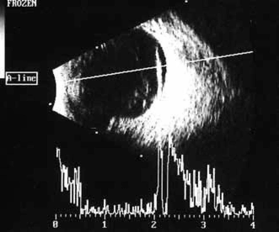 Pacientka č. 1: Ultrasonografie oka levého: krvácení intravitreální, hyperechogenní linie odpovídá trakčnímu odchlípení sítnice.