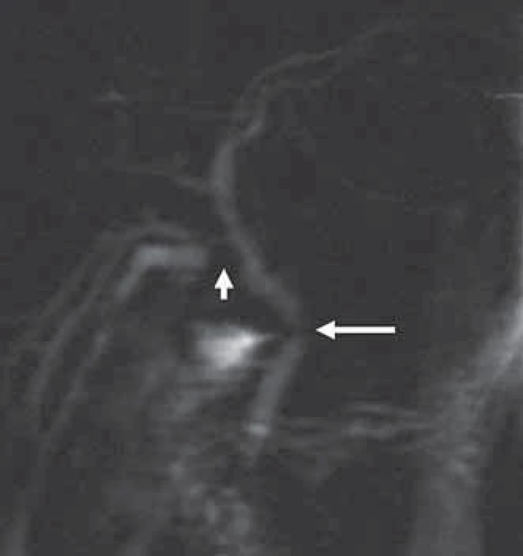 MRCP u stejného pacienta – stenóza ve střední části ductus choledochus (šipka) s obstrukcí pravého ductus hepaticus (malá šipka), s patrnou dilatací intrahepatálních žlučových cest nad danou obstrukcí po obtížné laparoskopické cholecystektomii.