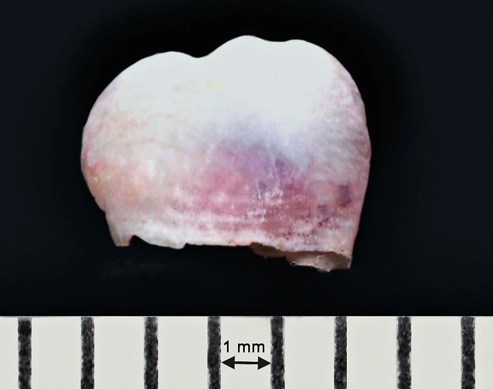 Extrahovaný natální zub prořezaný v místě levého dolního středního řezáku