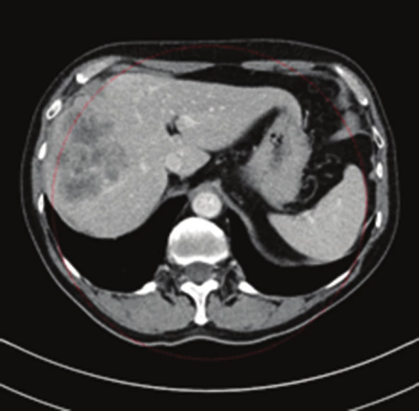 CT obraz metastatického postižení jater při karcinomu apendixu (venózní fáze, axiální řez)
Fig. 3: CT scan of liver metastases due to appendix cancer (venous phase, axial view)