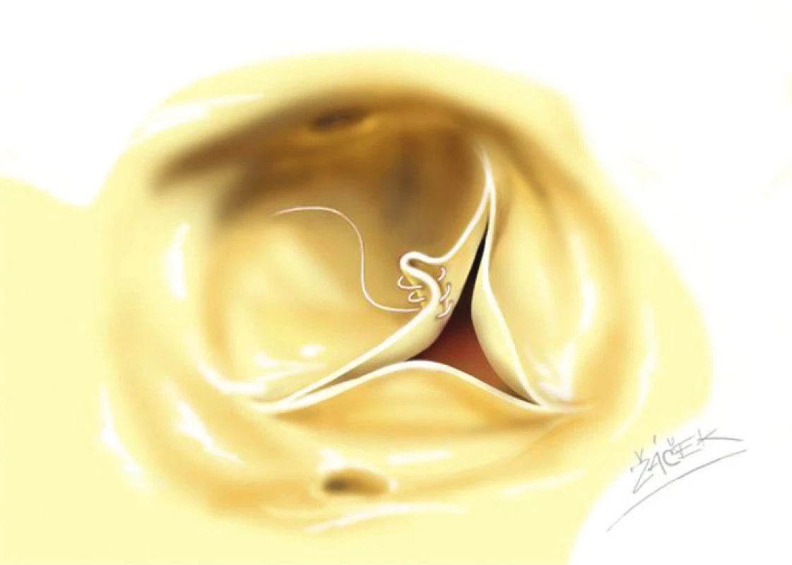 Zkrácení volného okraje prolabujícího cípu aortální chlopně jeho centrální plikací.