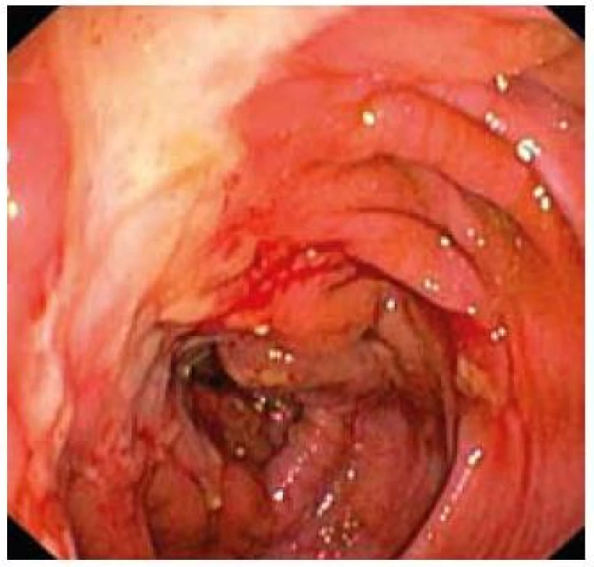 Tiahnuce sa ulcerácie sliznice colon ascendens.
Fig. 2. Far stretching ulcerations of mucosa in colon ascendens.