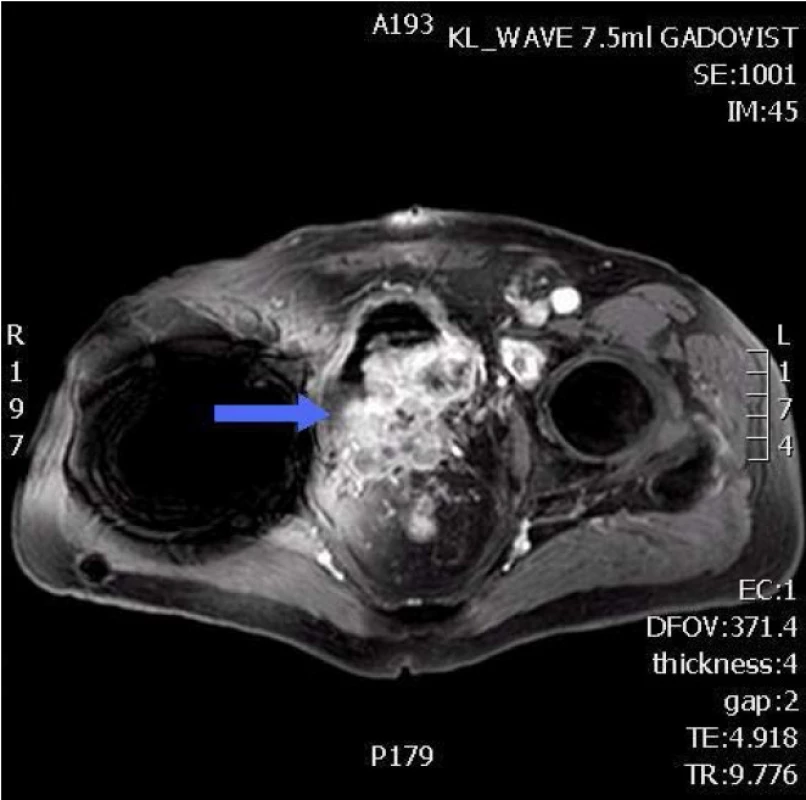 NMR pánve – pokročilý nádor močového měchýře
Fig. 3. Pelvic MRI – advanced bladder tumor