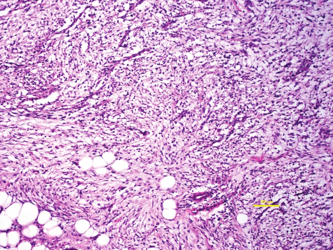 Nodulární fasciita může mít značně myxoidní vzhled. Pro svoji hypercelularitu, mitotickou aktivitu a někdy alarmující vzhled aktivovaných fibroblastů bývá zaměněna za maligní nádor.