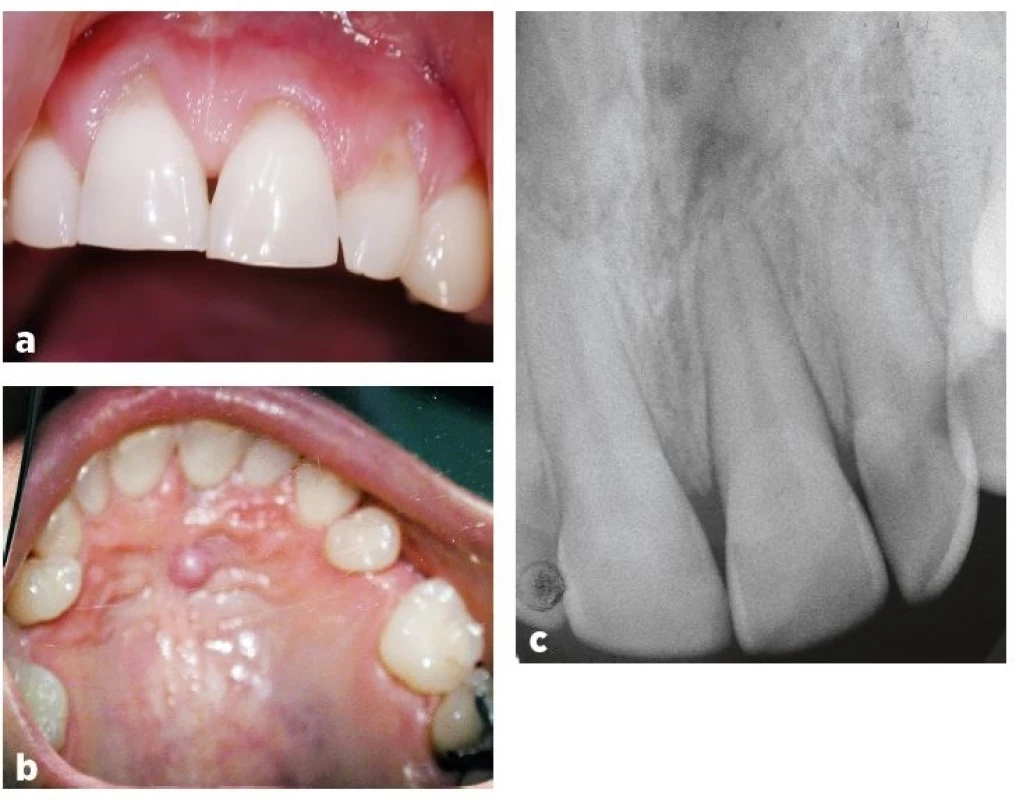 a, b, c Pohled na frontální úsek horního zubního oblouku ze strany vestibulární (a) a ze strany palatinální (b) (autoři se omlouvají za zhoršenou kvalitu fotografie), intraorální rentgenogram zubů 11–22 v Cieszyńského projekci (c)