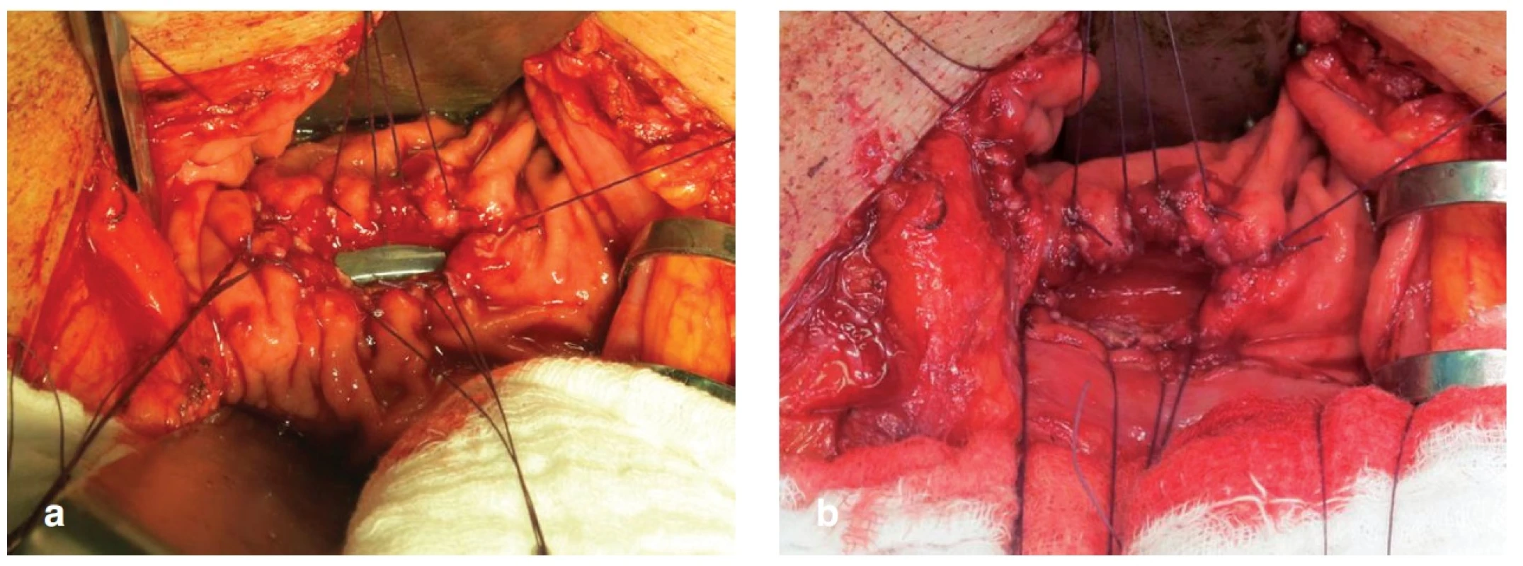 Kazuistika 1 – a) zadní gastrotomie nad zavedeným drénem, b) po vytažení drénu
Fig. 4: Case 1 – a) posterior gastrotomy over the drainage tube, b) drainage tube extraction