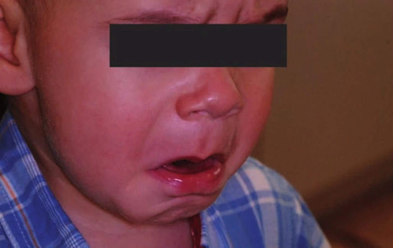Dítě před podáním analgosedace.
Fig. 2. The child befor interpretation the analgosedation.