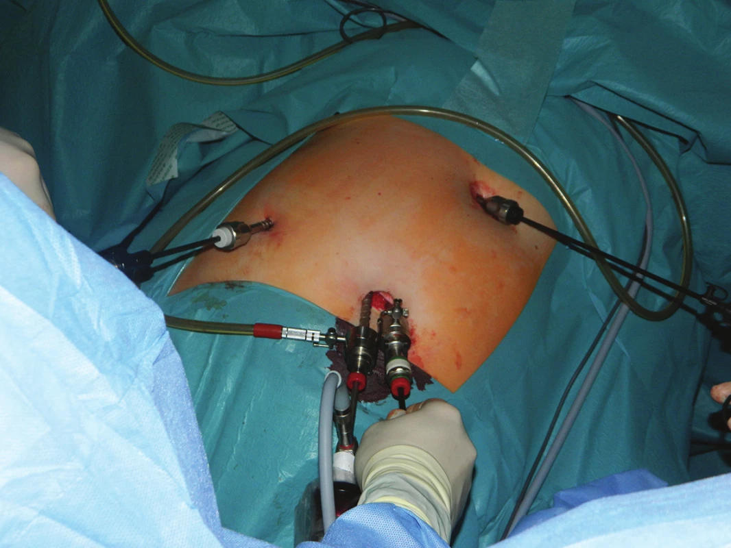 Konverze“ na laparoskopii z více vstupů
Fig. 3: “Conversion“ to multiple-ports laparoscopy