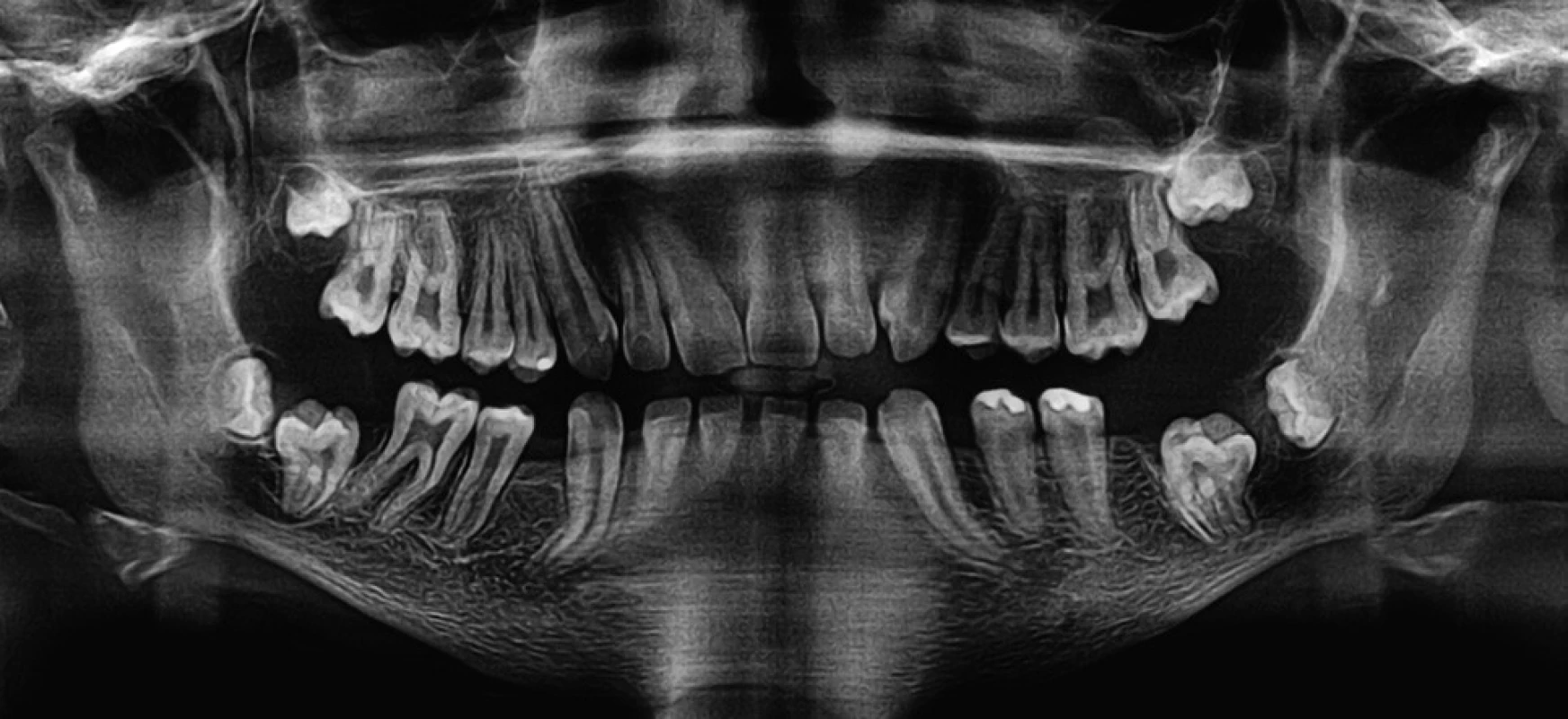OPG snímek, retence zubů 37, 47 a změny na hlavicích obou temporomandibulárních kloubů