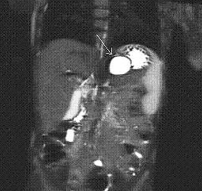 MRI – frontální řez, cysta označena šipkou
Fig. 2: MRI – frontal view, the cyst is marked with an arrow