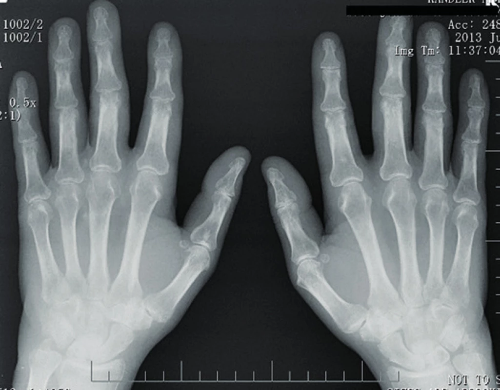 RTG rukou – periartikulární osteoporóza, zúžení kloubních štěrbin a erozivní změny na zápěstních kůstkách.