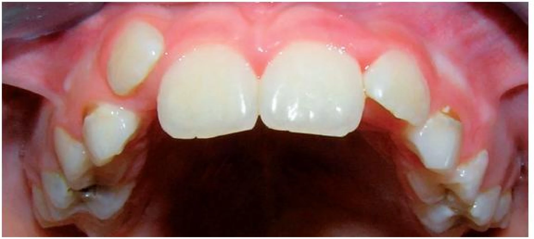 Horní zubní oblouk – frontální pohled