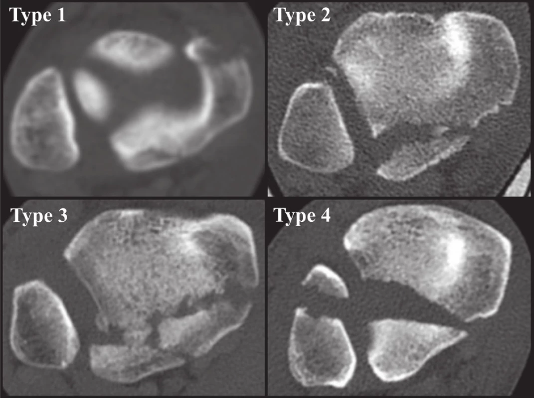 Anatomická 3D CT klasifikace z r. 2015 [34]
Jednotlivé typy z Obr. 6 na CT transverzálních CT řezech.
Fig. 9: Anatomical 3D CT classification published in 2015 [34]
Individual types from Fig. 6 on transverse CT scans.