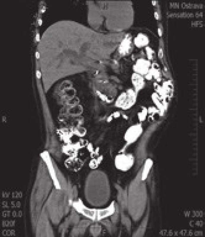 CT břicha s dilatací žlučových cest a metastatickým postižením hlavy pankreatu.
Fig. 1. CT abdomen with dilatation of the bile duct and pancreatic head metastasis.