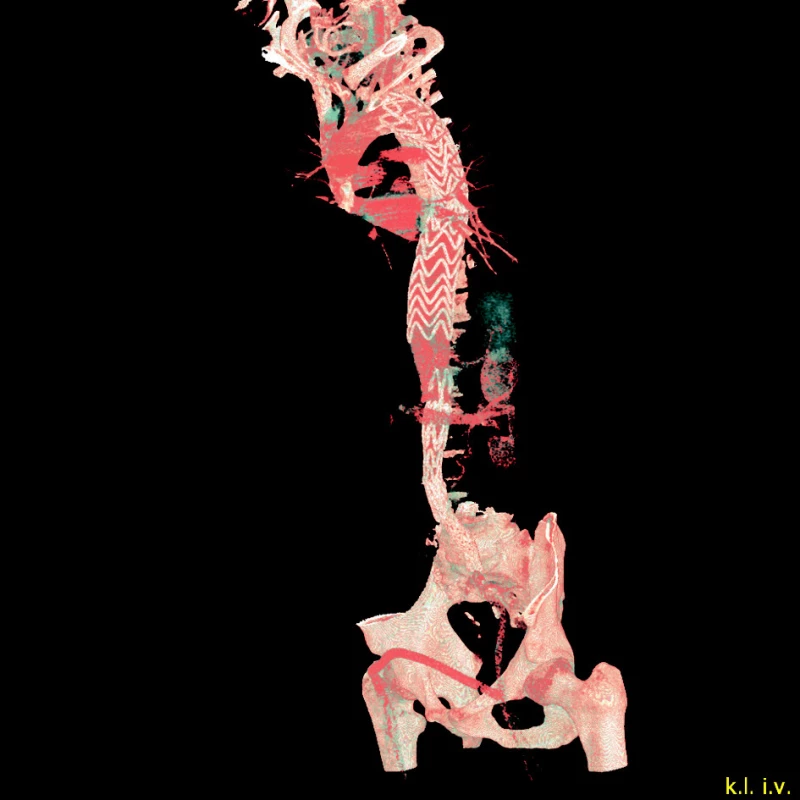 Aortouniiliacký stentgraft s nekrytým suprerenálním hrdlem a femorofemorální zkřížený bypass
Fig. 4. An aortouniiliac stentgraft with an open suprarenal column and a femoro-femoral cross-over bypasss
