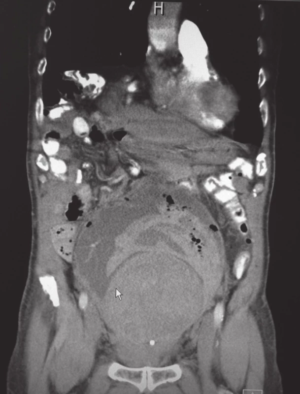 CT sken s patrnou objemnou prostatou dosahující k pupku, zbytek močového měchýře je vyplněný koaguly
Fig. 1. CT scan with a huge prostate reaching to the belly buttom, the rest of the bladder is filled clot with coagulum