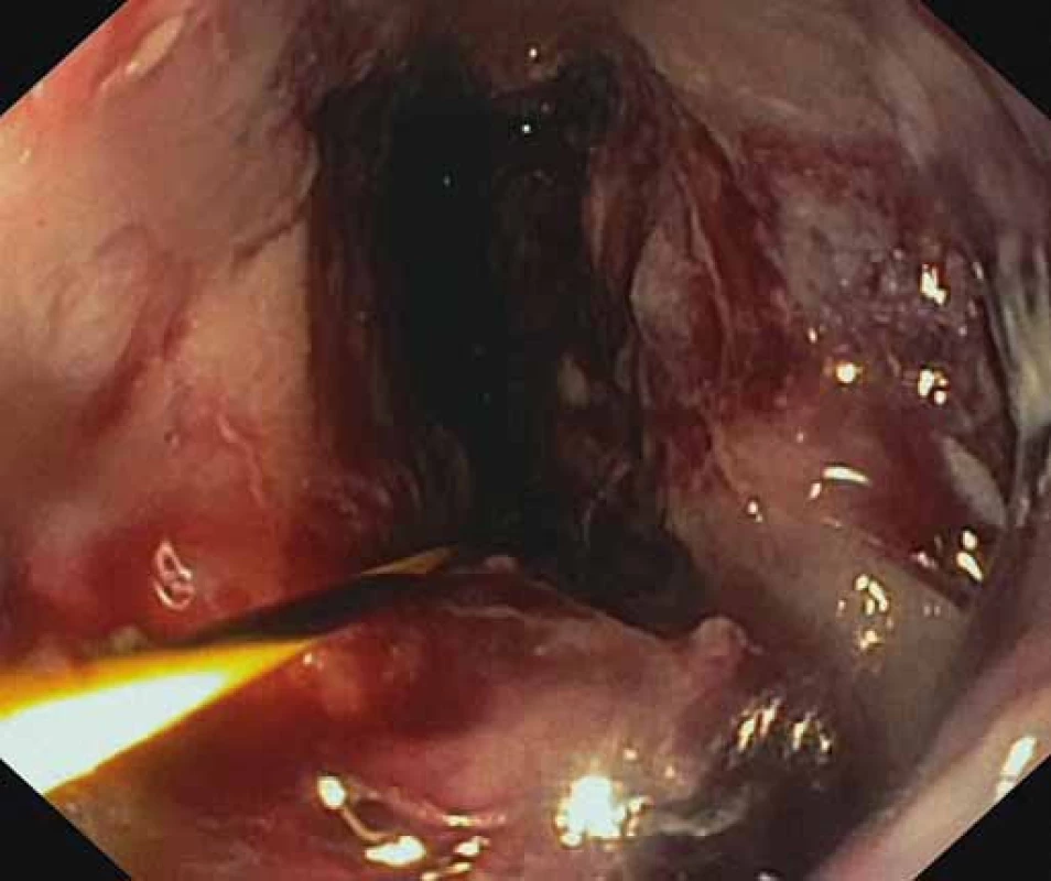 Viabilné granulačné tkanivo na spodine nekrózy po úspešnej nekrektómii.
Fig. 4. Viable granulation tissue after a successful necrectomy.
