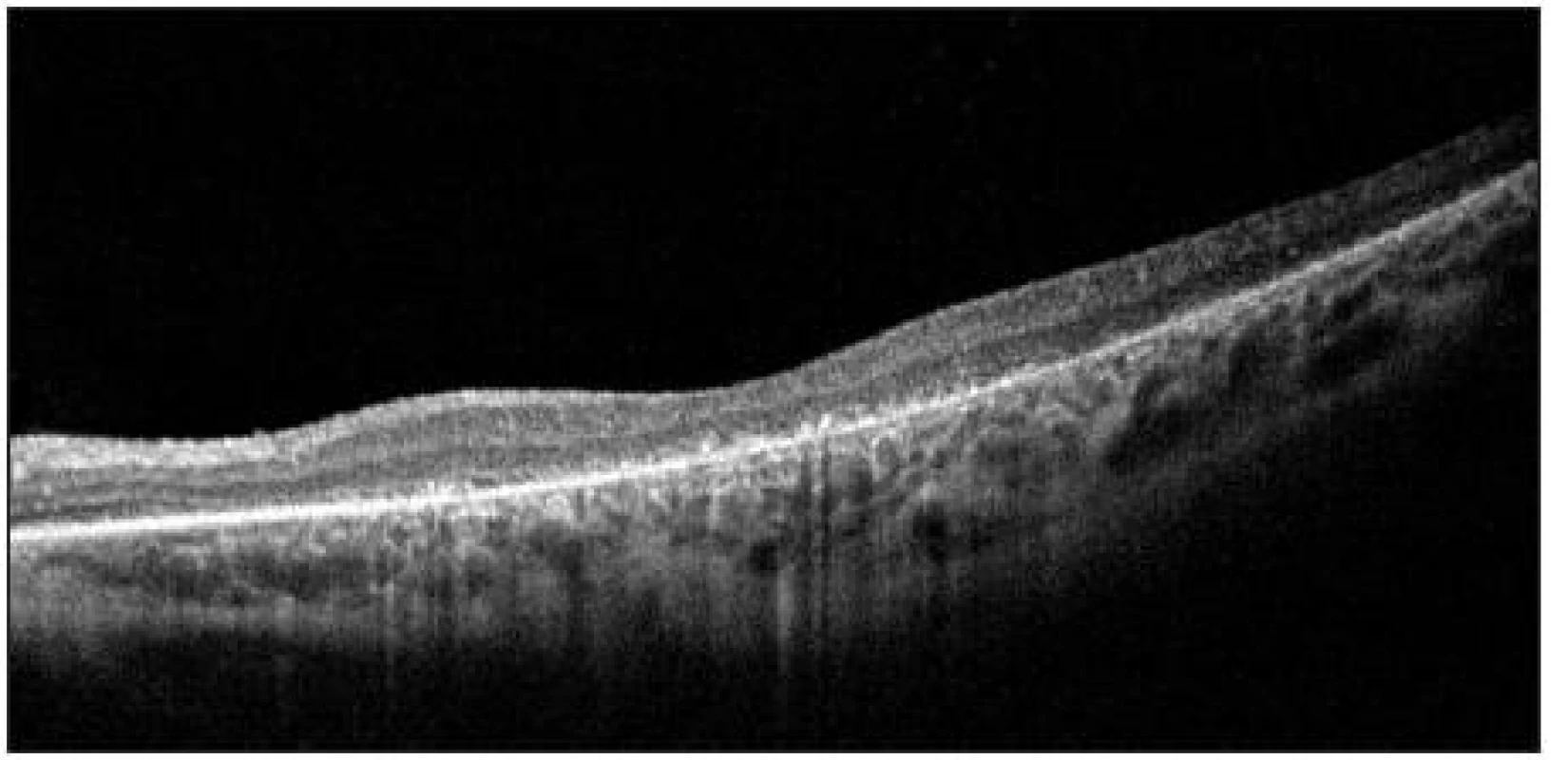 OCT nález u pacienta s pigmentovou dystrofiou s viditeľnou atrofiou vonkajších vrstiev sietnice
