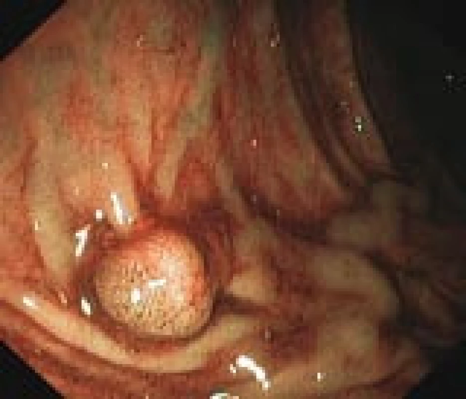 Přisedlý polyp v endoskopickém obraze během kolonoskopie (vlastní materiál).