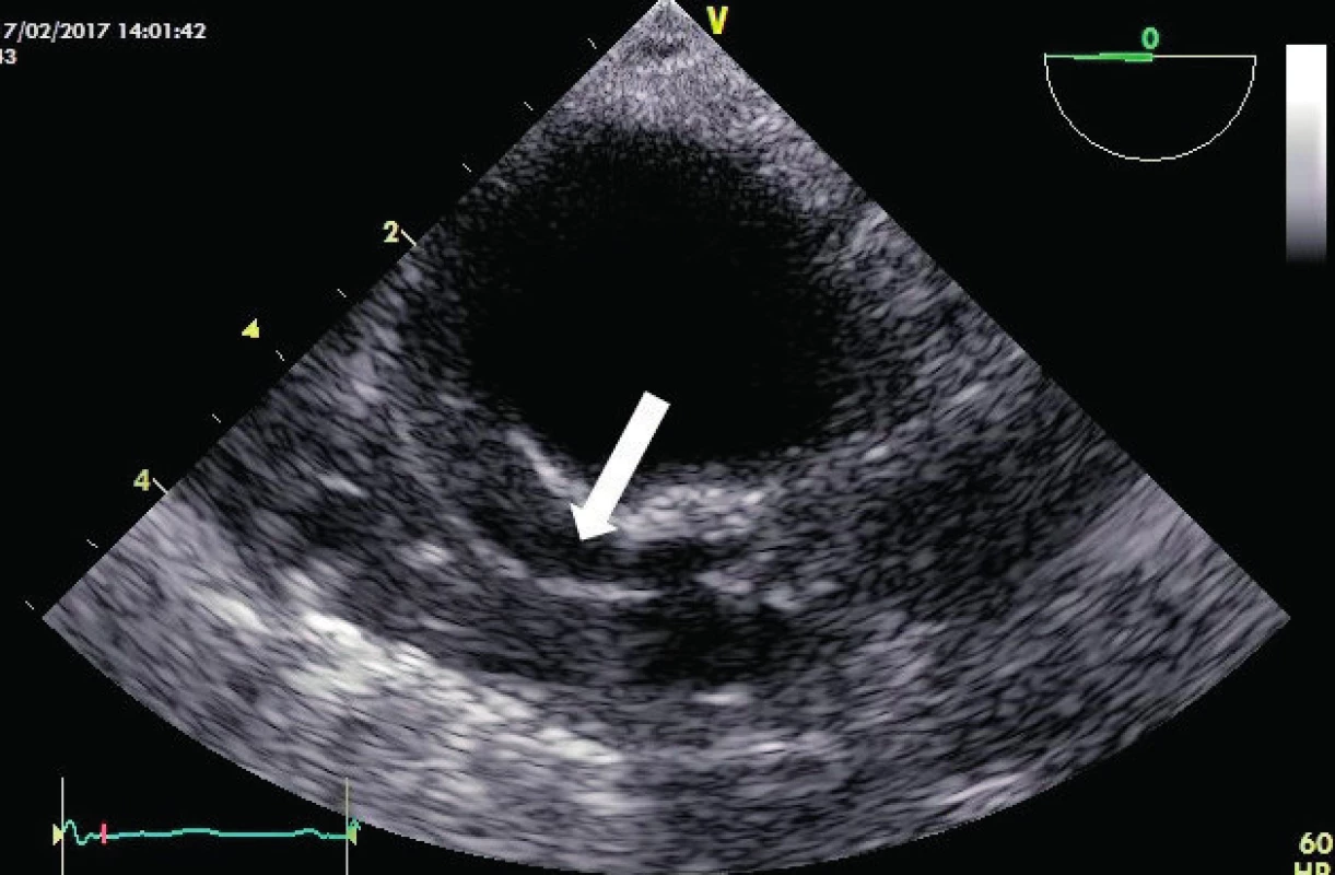 Intramurální hematom
TEE obraz sestupné aorty v krátké ose s hematomem v zesílené stěně (bílá šipka) při absenci odtržené intimy.