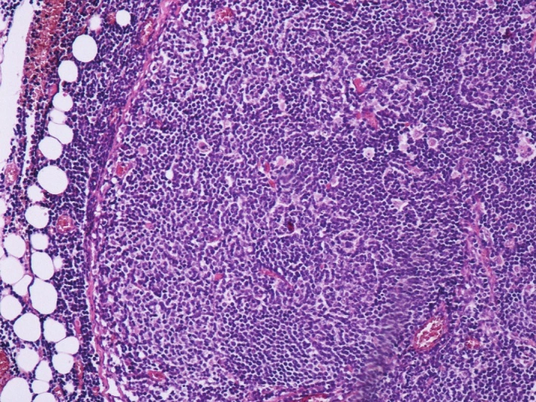Kazuistika 1 – B-lymfom z buněk plášťové zóny – lymfatická uzlina s difuzním setřením základní struktury a s lymfomovou infiltrací okolní tukové tkáně (HE, 40x)
Fig. 2: Case 1 – B-cell mantle cell lymphoma – lymph node with diffuse effaced basic structure and with lymphoma infiltration of the surrounding fat tissue (HE, 40x)