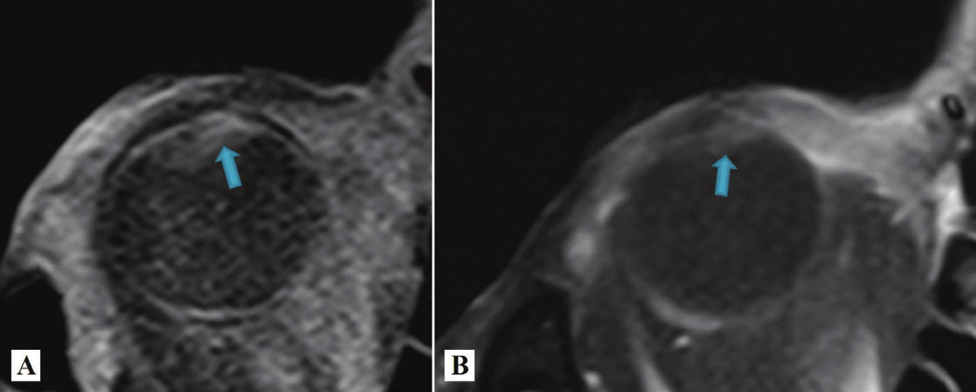 Porovnanie MR obrazov pacienta v r. 2012 pred ožiarením (A) a v r. 2015, t.j. 3 roky po ožiarení je prítomná viditeľná redukcia objemu tumoru (B)