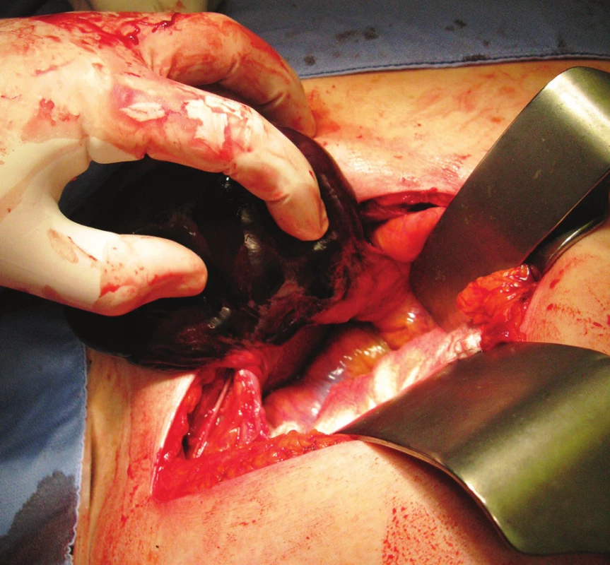 Gangrenózní hydropický žlučník, torze v místě cévního svazku
Fig. 3: Gangrenous and hydropic gallbaldder, torsion of the vascular bundle