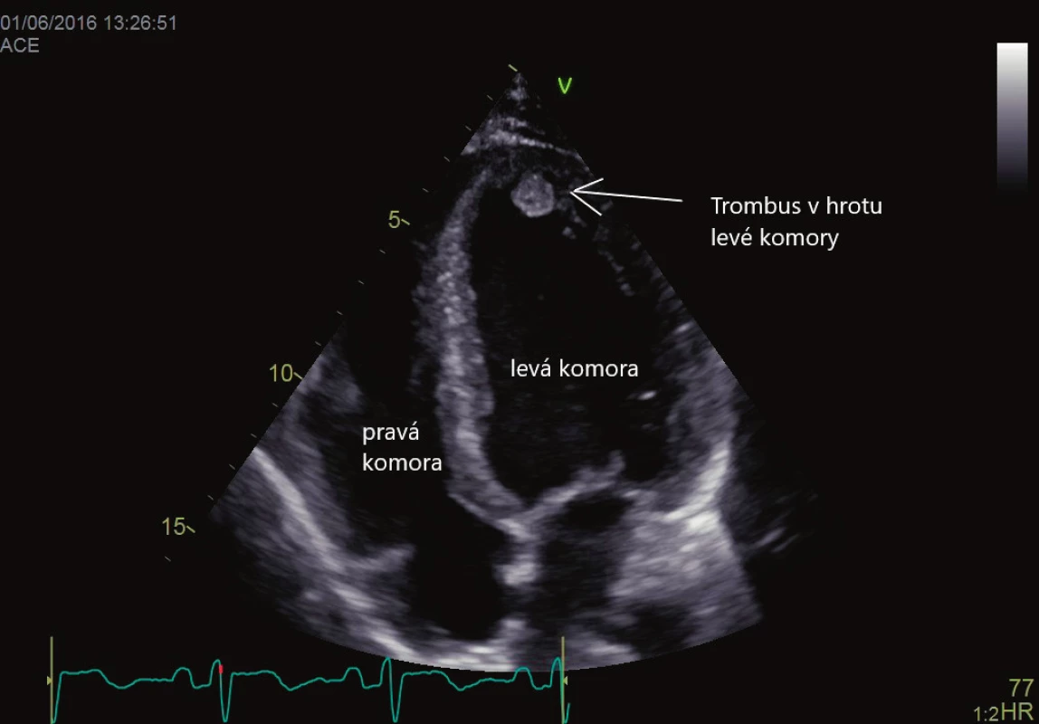 Trombus v hrotu levé komory srdeční. Vyšetření transtorakální echokardiografií
