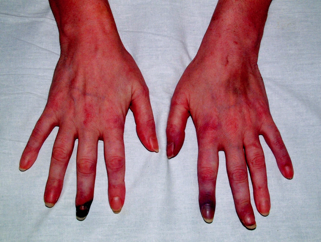 Ischemické změny prstů HK podmíněné SLE s antifosfolipidovým syndromem.