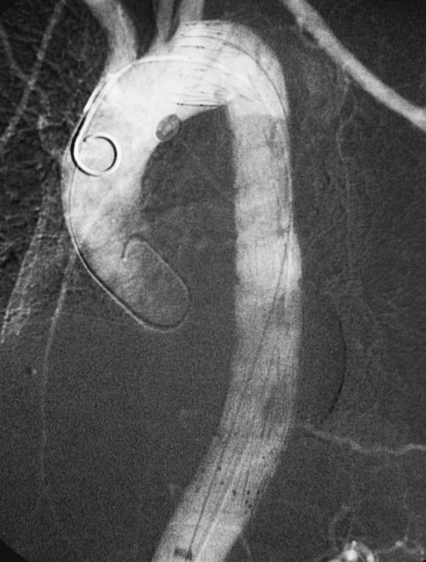 Stav po úspěšném zavedení hrudního stentgraftu
Pic. 7. Thoracic stentgraft, successfully introduced