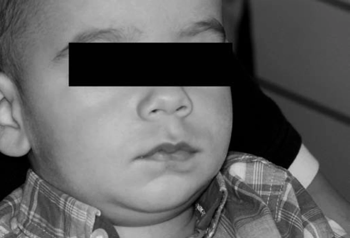Dítě po podání analgosedace.
Fig. 3. The child after interpretation the analgosedation.