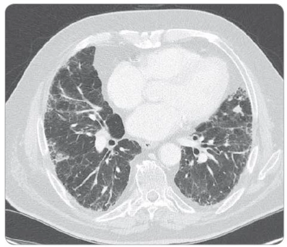Rozvoj plicní fibrózy, regrese plicních metastáz (květen 2015).