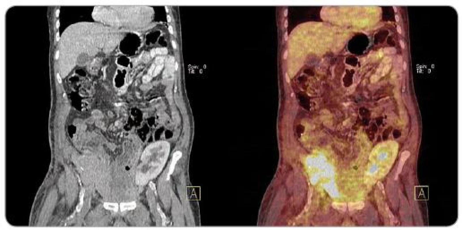 PET/ CT obraz velké metastázy karcinomu z Merkelových buněk do transplantované slinivky (pravá jáma kyčelní) u pacienta po kombinované transplantaci slinivky a ledviny (levá jáma kyčelní).