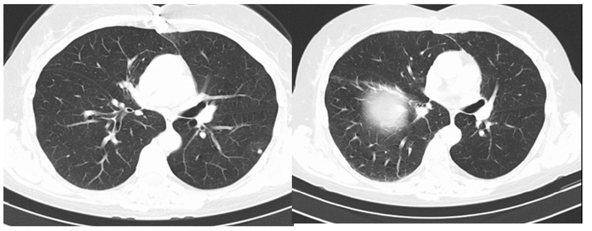 CT vyšetření hrudníku před léčbou nivolumabem a po
10 měsících léčby, regrese některých plicních metastáz