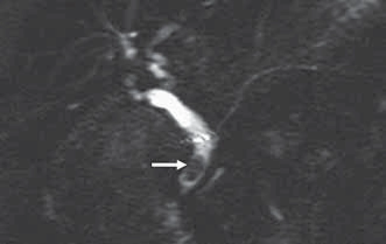 MRCP s defektem v náplni ve střední části ductus choledochus odpovídající choledocholitiáze (šipka).