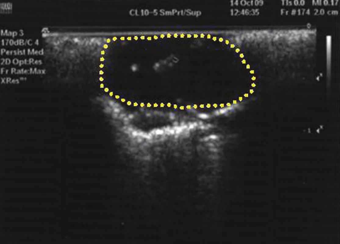 Nález maligního tumoru plic při sonografii endoskopickou UZ sondou
Pic. 4. Display of malignant pulmonary tumour through the endoscopic ultrasonic sonde