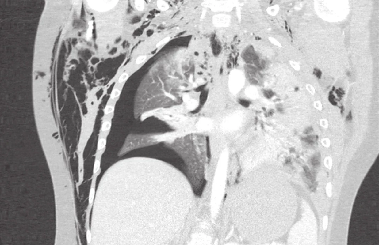 CT vstupní nález u 15letého účastníka autonehody: kontuzní změny levé plíce s hemothoraxem vlevo, pneumothorax vpravo s komunikací do podkožního emfyzému, dislokovaná fraktura 2. žebra vpravo. Součástí polytraumatu edém mozku, fisura sleziny, zlomenina tibie. Poranění hrudníku zhojeno při UPV, bilaterální hrudní drenáži a objemové resuscitaci oběhu.
Fig. 1: Initial CT findings in a 15 years old boy after a car accident. Lung contusion with haemothorax on the left, pneumothorax communicating with subcutaneous emphysema,
and dislocated fracture of the second right rib. There were associated injuries: posttraumatic brain oedema, splenic fissure and tibial fracture. The thoracic trauma healed up with ventilatory support, bilateral thoracic drainage and fluid resuscitation.