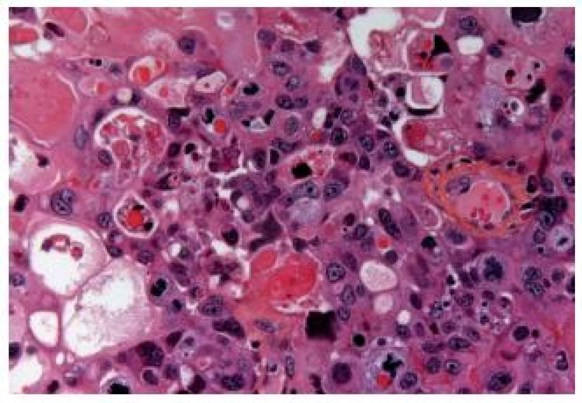 Large cell UC, with severe atypia and poor differentiation. This type can be problematic to be recognized as a primary UC.