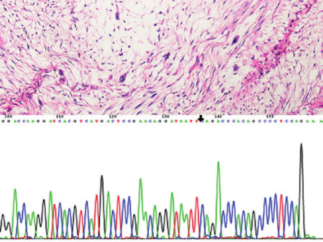 Kazuistika 2. Low grade fibromyxoidní sarkom. Ložiskově jsme pozorovali velké atypické buňky s nápadným jaderným polymorfizmem, které byly pozitivní v průkazu proteinu Ki-67. Barveno hematoxylinem a eozinem (původní zvětšení 200x). Vložený obrázek: Sekvenogram znázorňující fúzní gen FUS/CREB3L2, produkt translokace t(7;16) s variantním místem zlomu. Šipkou je znázorněna fúze části exonu 9 genu FUS s exonem 5 genu CREB3L2.