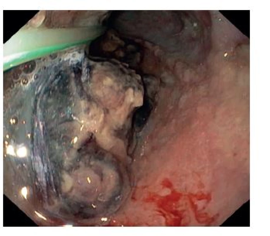 Gastroskopický snímek po 7 dnech s prolabujícím hematomem
Fig. 2: Upper endoscopy image after 7 days with obturating haematoma