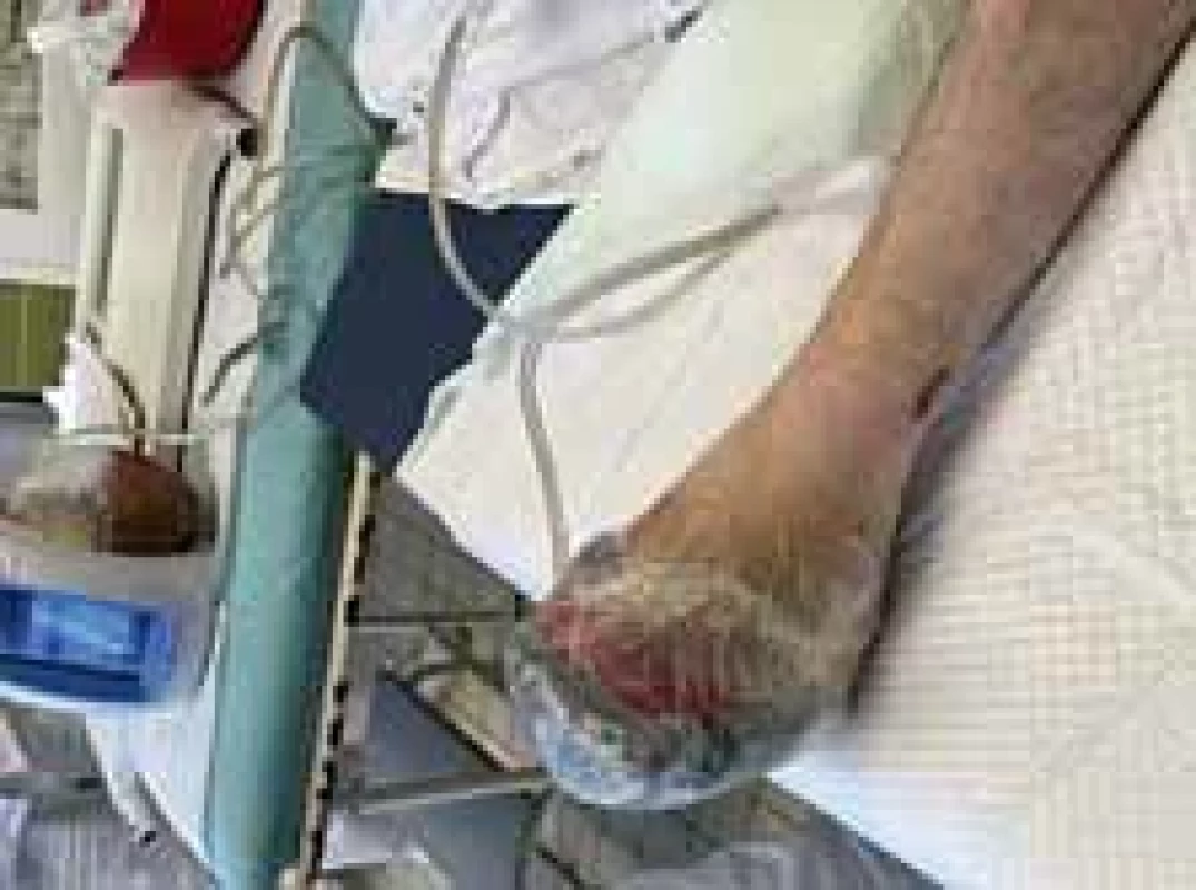 Application of vacuum assisted closure (VAC) therapy after open transmetatarsal amputation.