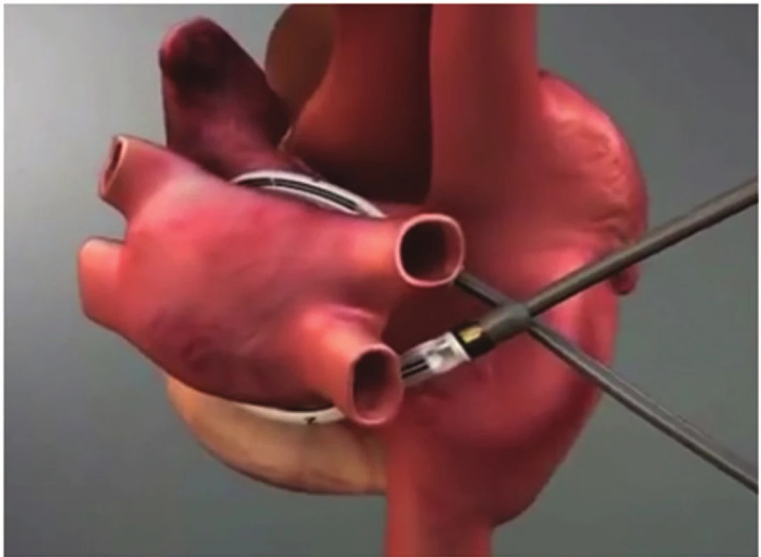 Schéma umístění ablační sondy kolem plicních žil
Fig. 1: Position of the catheter around pulmonary veins