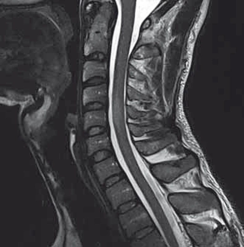 MRI of the cervical spine.
A solitary, slightly expanding enhansing lesion at the C4–C5 level.