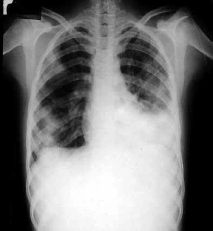 Zadopřední skiagram hrudníku nemocného s pneumocystovou pneumonií